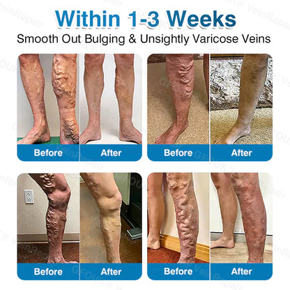 US✅🌱 VeinRepair Microneedle Patch Roll⚡Instant Relief, Long-Term Results